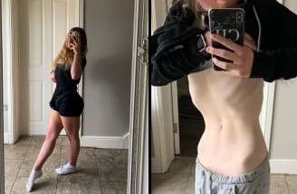 Anorexia ju takmer zabila! Zachránil ju malý Simba